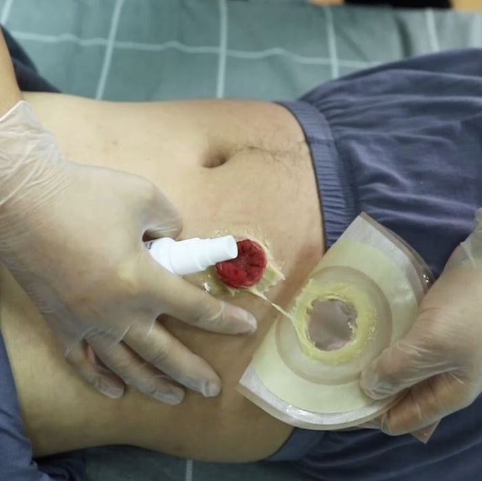 How to change ostomy bag? – ZQT Medical Care Store